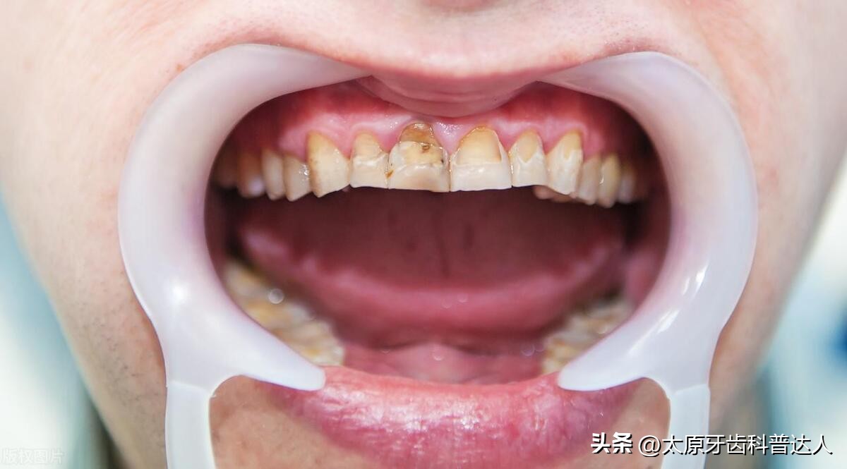 氟斑牙洗牙能变白吗图片高清,氟斑牙用什么方法进行美白