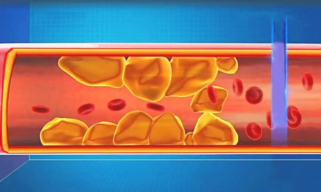 动脉瘤蛛网膜下腔出血术后并发症,动脉瘤导致蛛网膜下腔出血严重吗