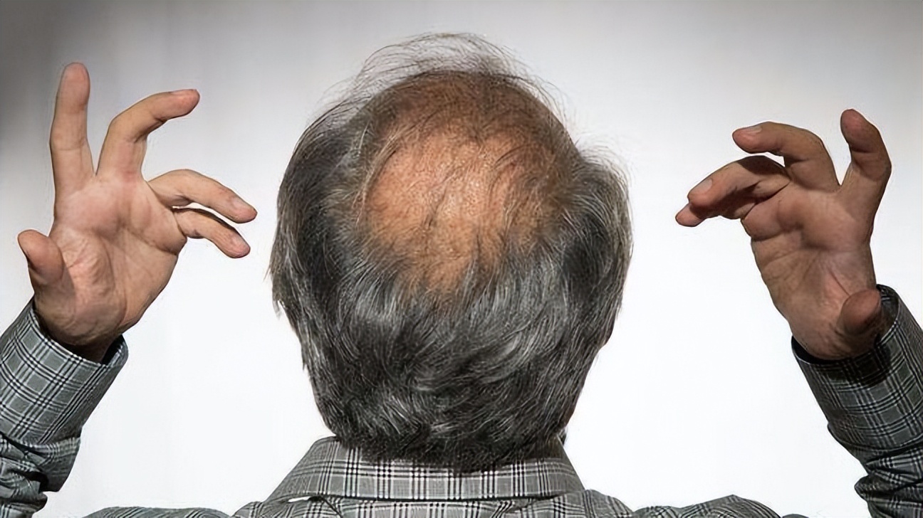 脱发为什么都是从头顶先秃,脱发为什么先从头顶脱