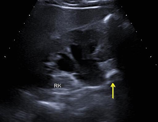 肾结石掉下来不疼,肾上的结石会引起腰痛吗