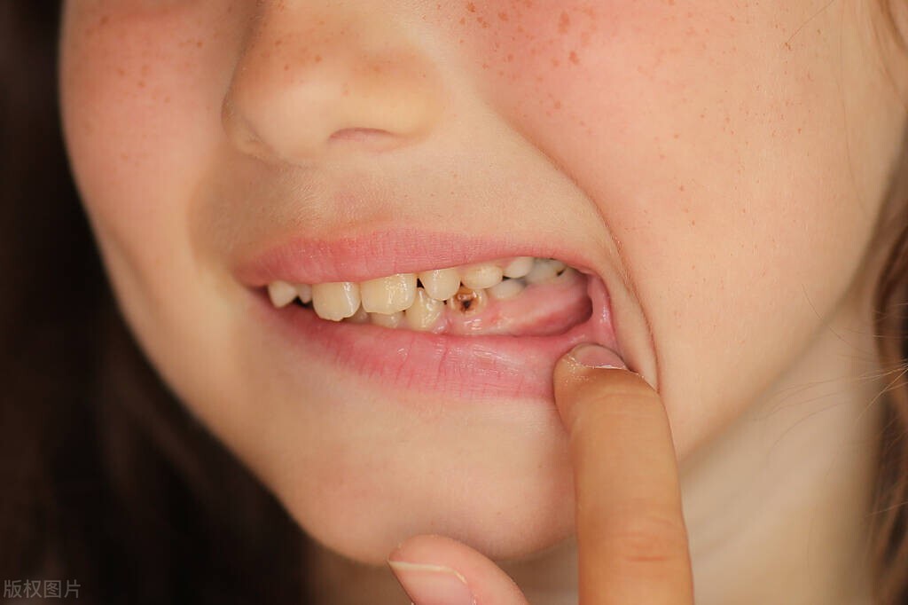 乳牙龋齿有必要治么,乳牙龋齿严重有没有补的必要