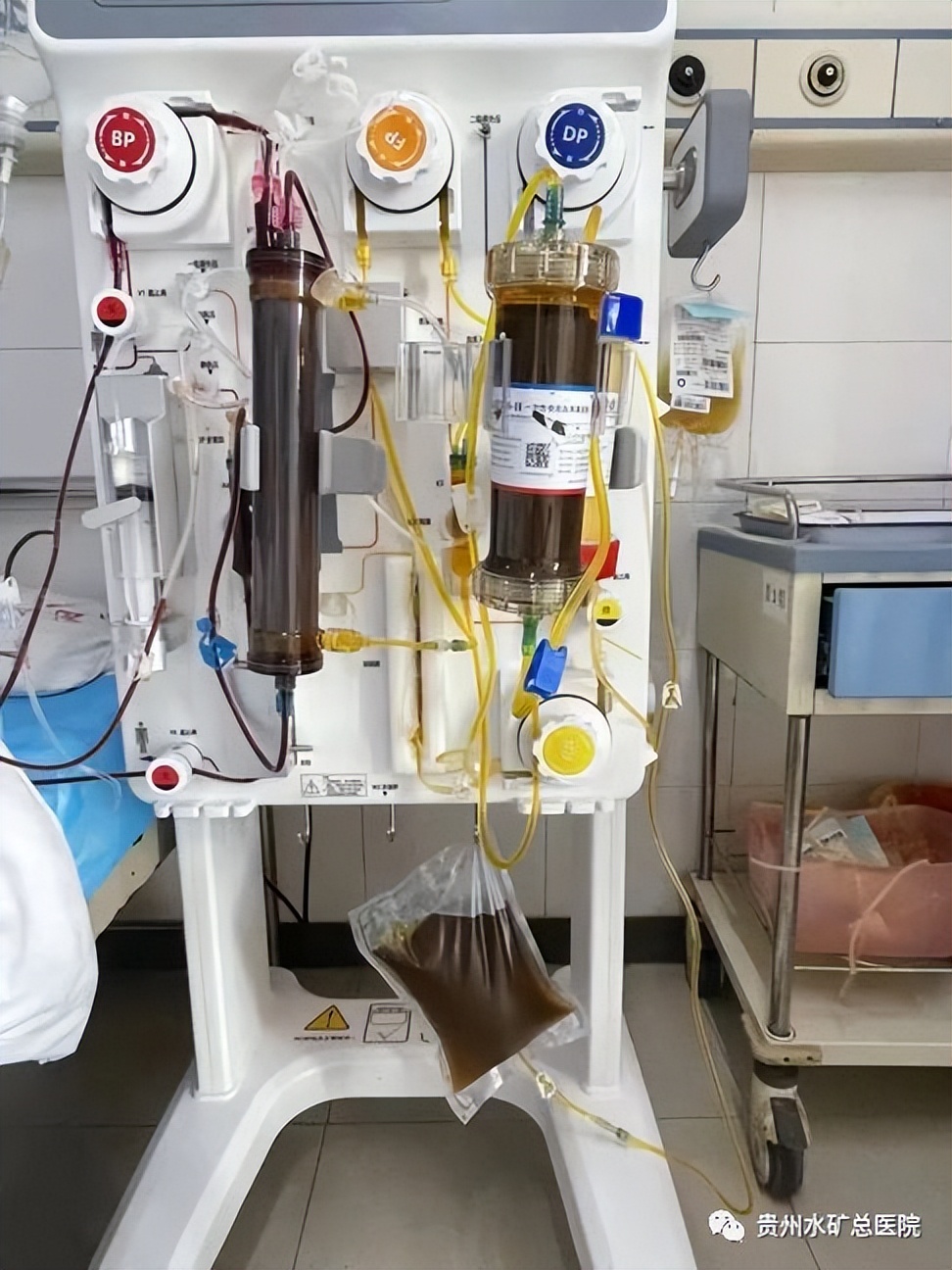 肝衰竭没有钱做肝移植怎么办,急性肝衰竭人工肝间隔多久做一次