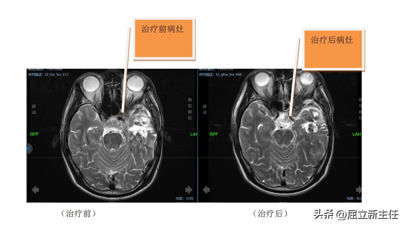 脑瘤复发怎么办,良性脑瘤复发了怎么办