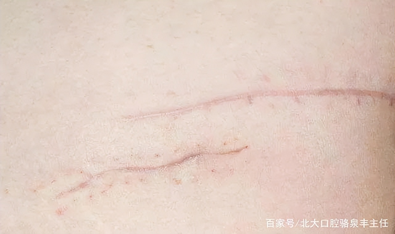 疤痕形成的原因及解决方法,疤痕怎么形成