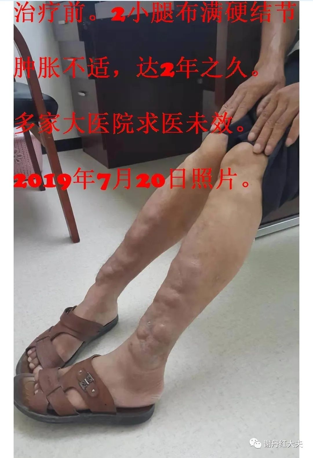 胫前黏液性水肿见于哪些病,胫前黏液性水肿为凹陷性水肿吗