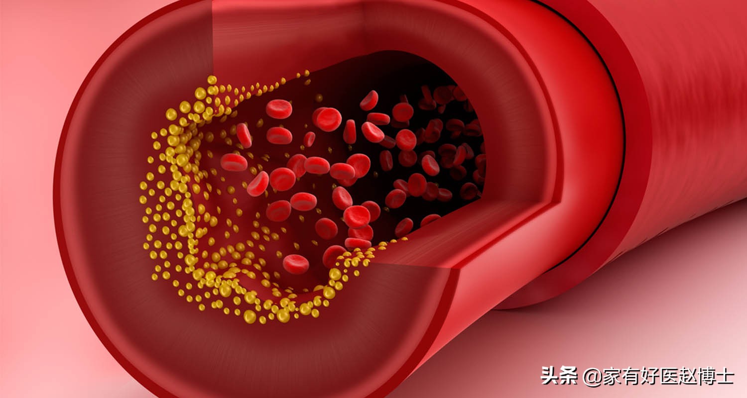 影响低密度脂蛋白胆固醇的因素,影响高胆固醇血症的因素