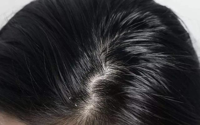 头皮为什么总长疙瘩和脓包,头皮总是长疙瘩或脓包是什么原因