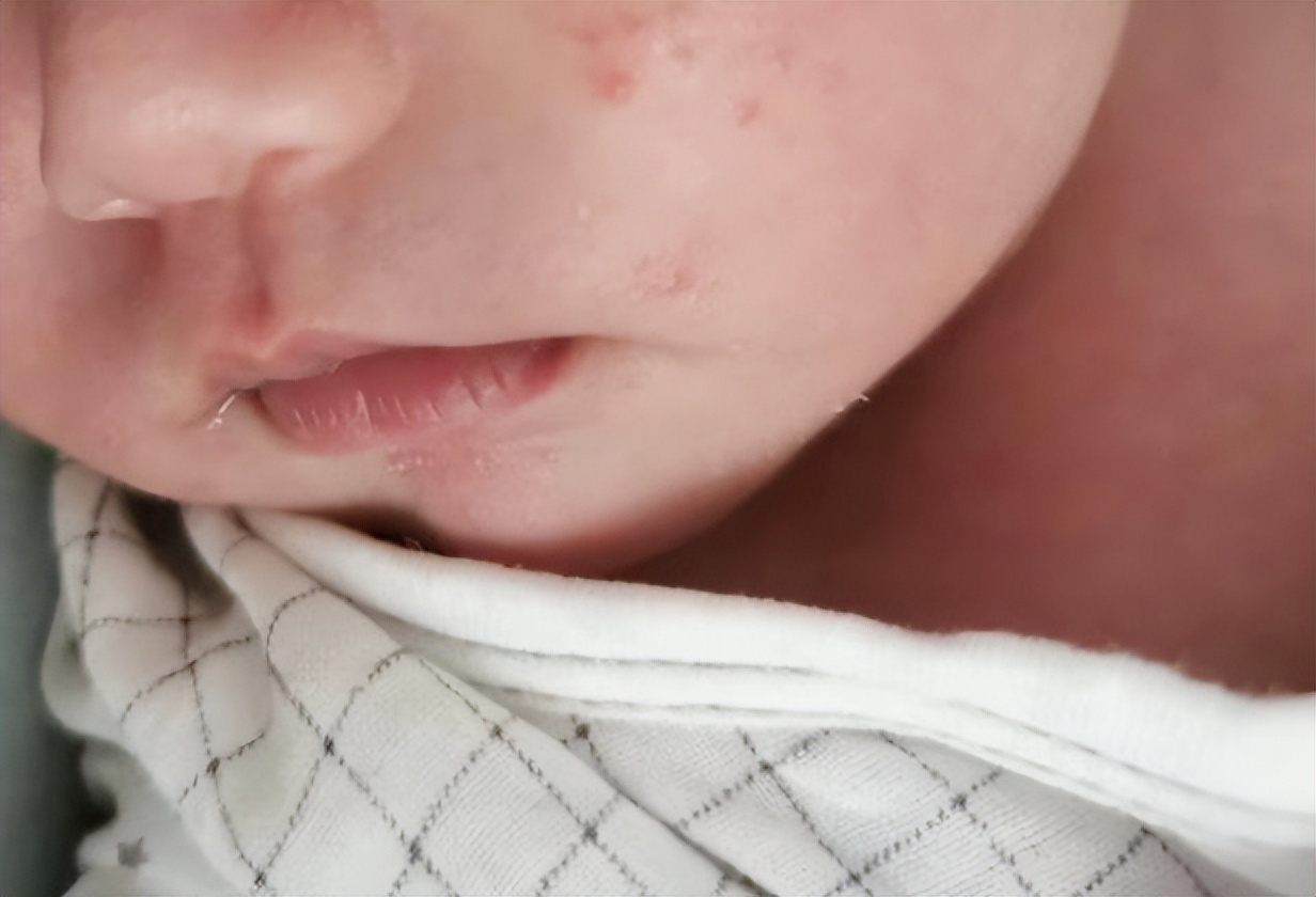 宝宝湿疹一直反复怎么断根,宝宝湿疹反反复复如何彻底根除