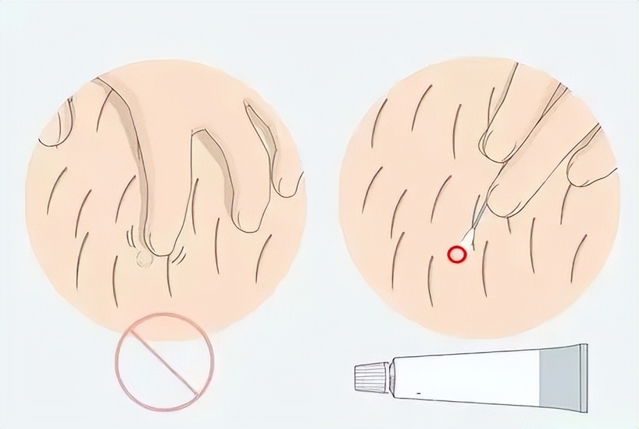 背后长了好多痘痘是性病吗,脖子下面长痘痘是性病吗