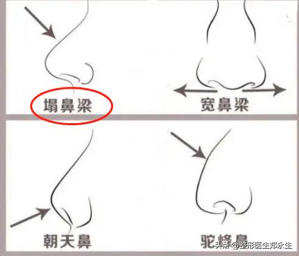 被老公打歪鼻骨留下后遗症,女的鼻子被打歪了