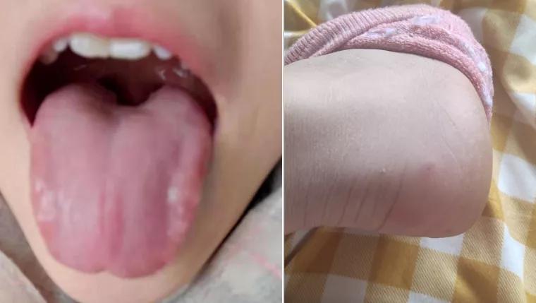 倪海厦当归四逆汤治冻疮,冻疮用四逆汤还是当归四逆汤