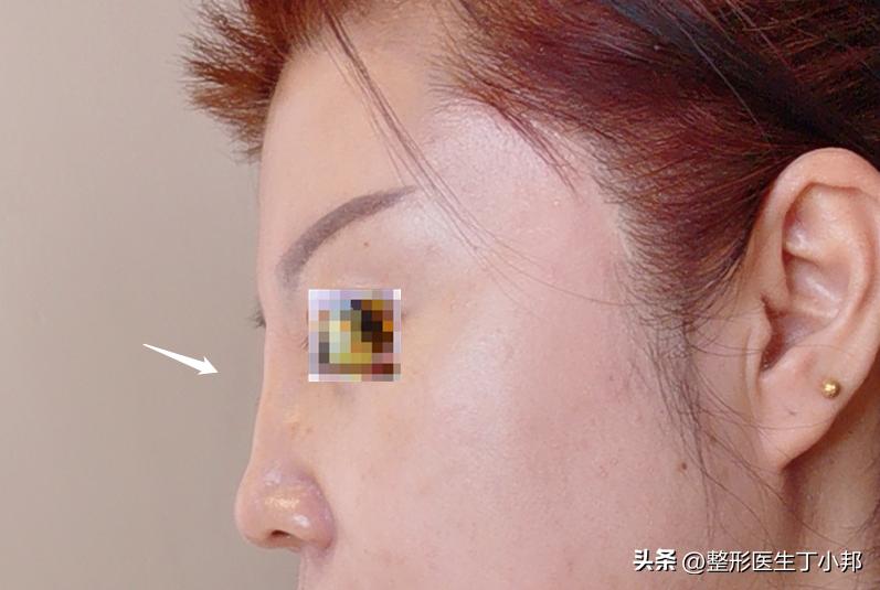 手术室实拍：手术中取出来的微晶瓷。#丁小邦注射物取出#故事