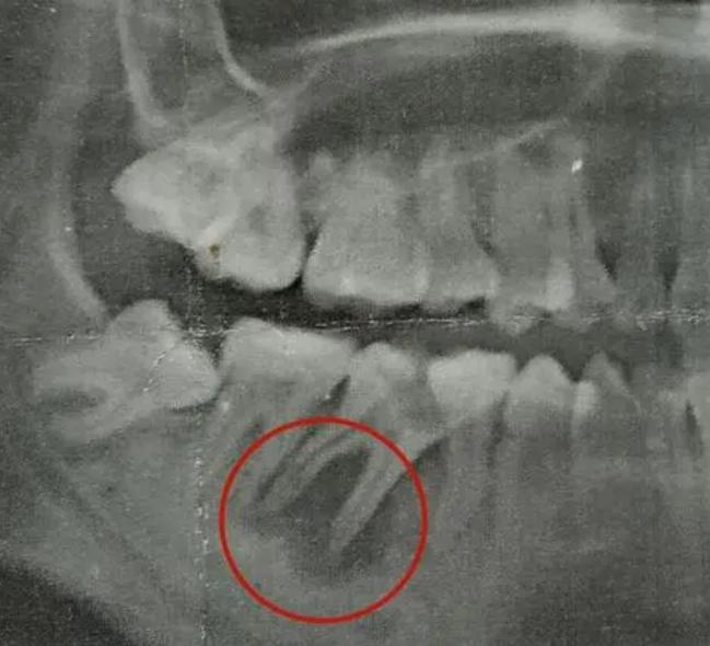 烂牙但是不痛,烂牙不痛也会出血怎么办