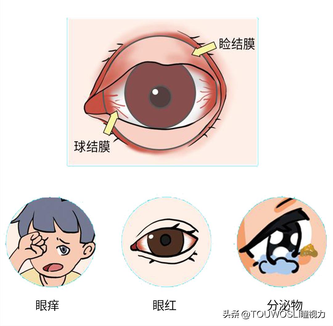 得了结膜炎要注意什么,慢性结膜炎要注意哪些事项