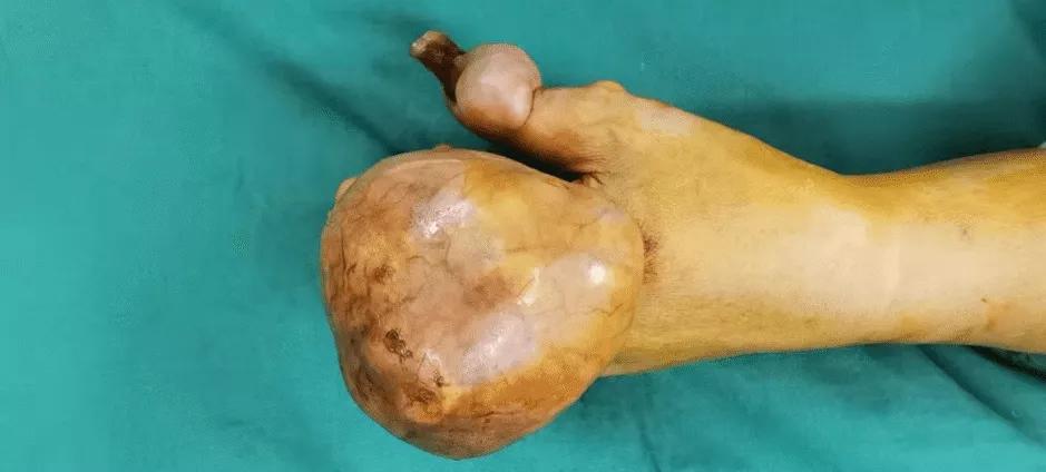 如何区别黑痣和黑色素瘤,怎样区别黑痣和黑色素瘤