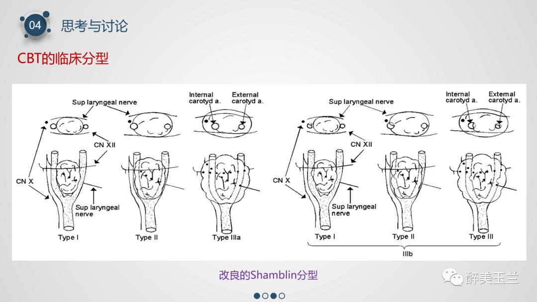 颈动脉体瘤切除术患者的麻醉管理,PPT课件