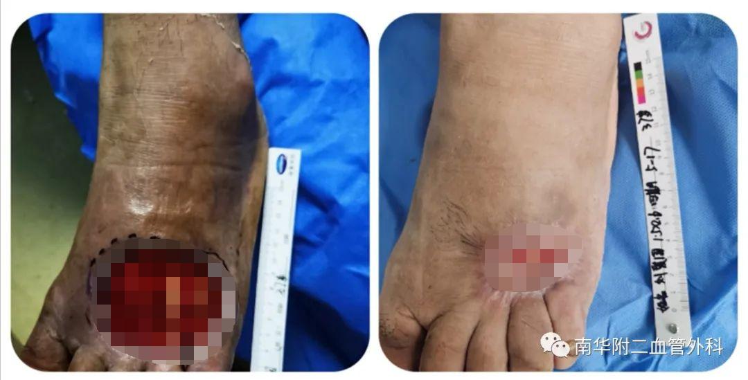 慢性创面治疗中心,创面治疗门诊