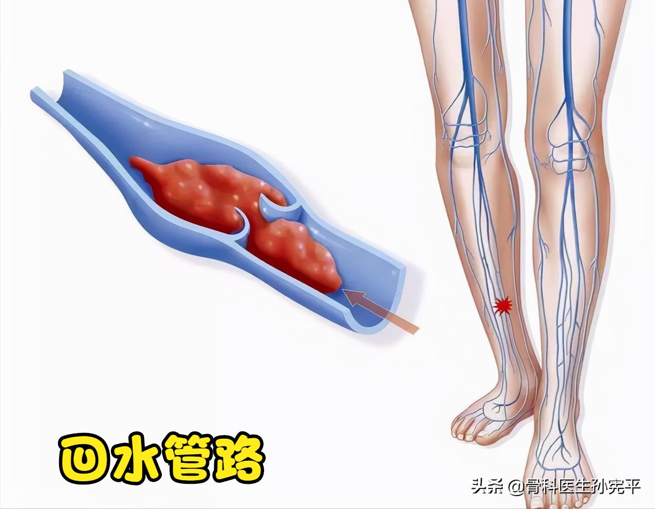 左下肢水肿的原因和治疗,儿童下肢水肿是什么原因