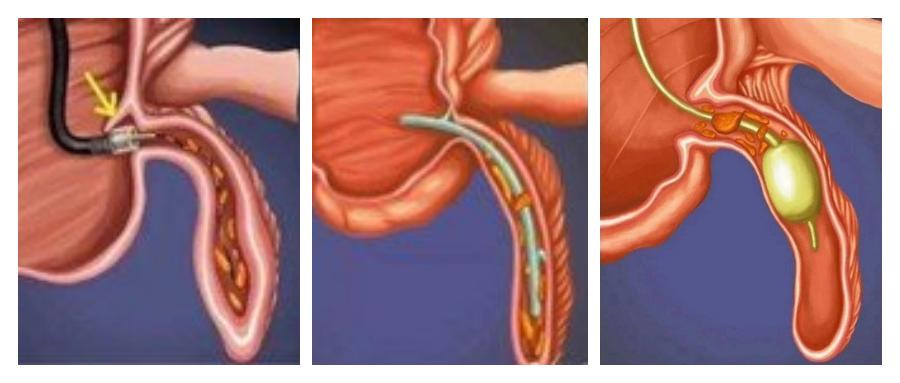 内镜下逆行性阑尾炎治疗术,长沙内镜逆行性阑尾炎治疗术