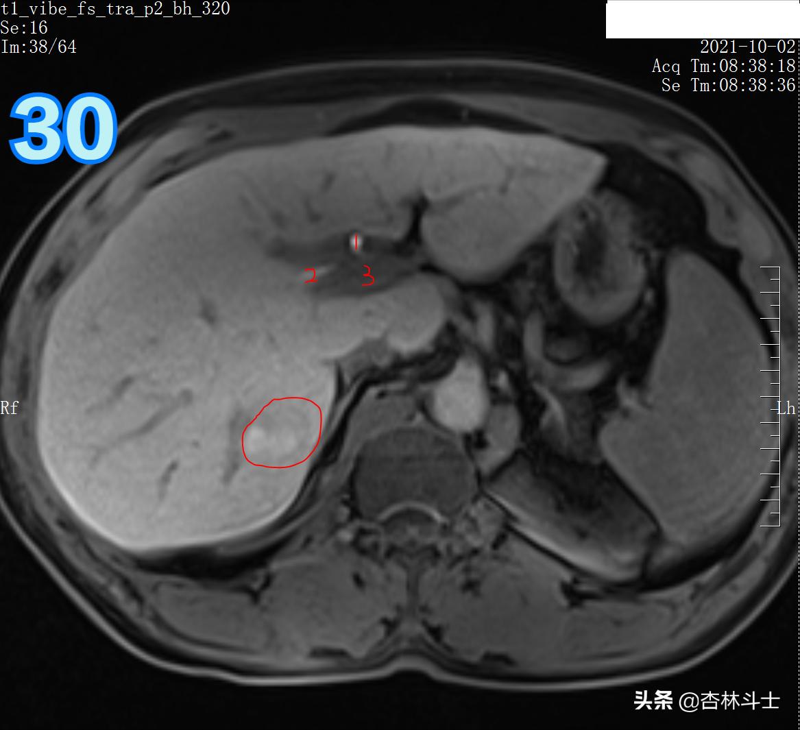 肝癌8公分肿瘤能活多久,肝癌细胞最大长多大