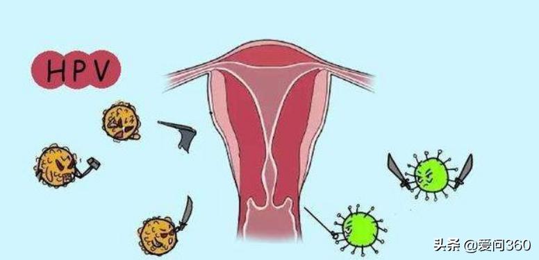 宫颈常见问题及预防有哪些,得了宫颈炎要注意什么呢
