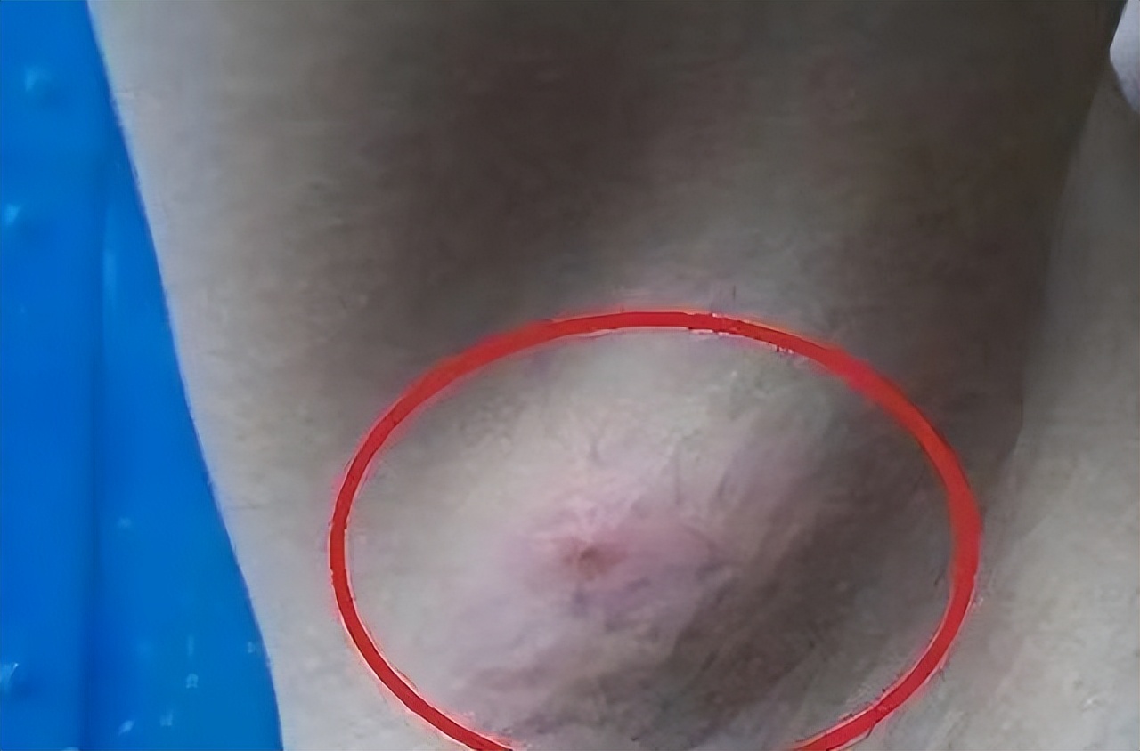 26岁女性腋下淋巴结肿大,艾滋患者是不是腋窝肿大结节