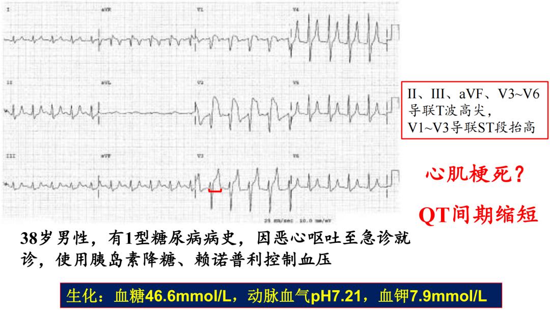 t波高尖心电图判断标准,t波高尖判断标准