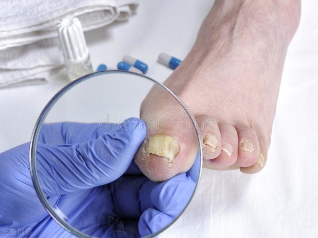 怎样治灰指甲不走弯路,灰指甲治好了就是正常的指甲了吗