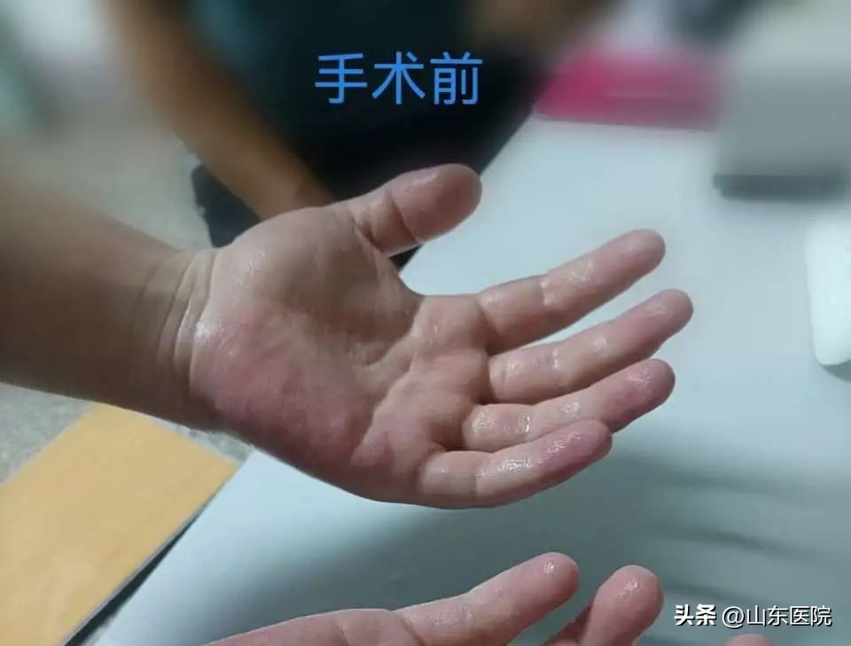 手汗症心胸外科微创手术,手汗症建议做微创吗