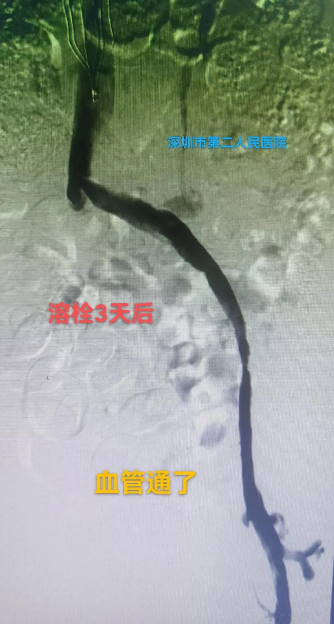 病人腿肿如何消除,病人腿肿了怎么回事