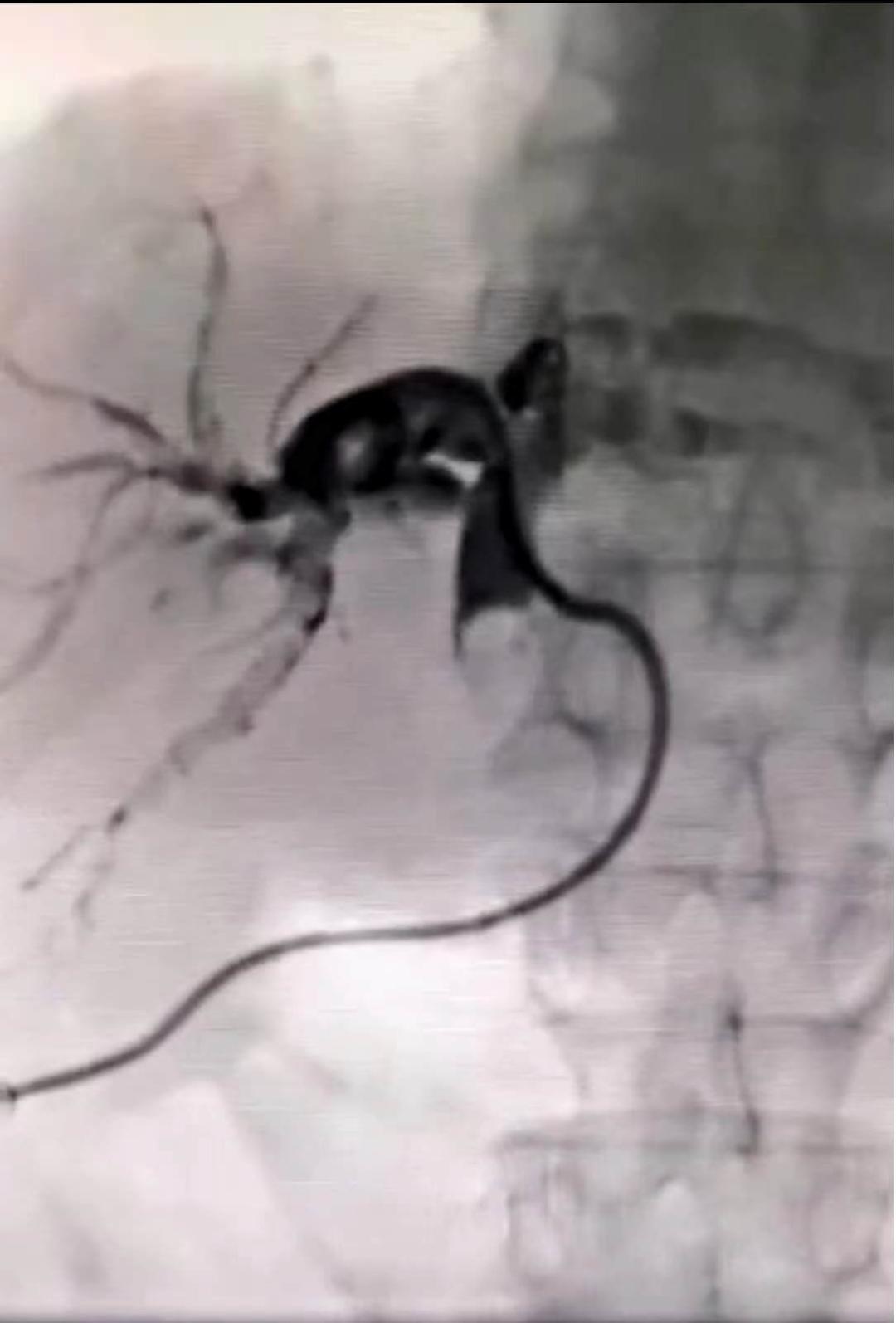 超声介入流程及注意事项,超声介入和b超的区别