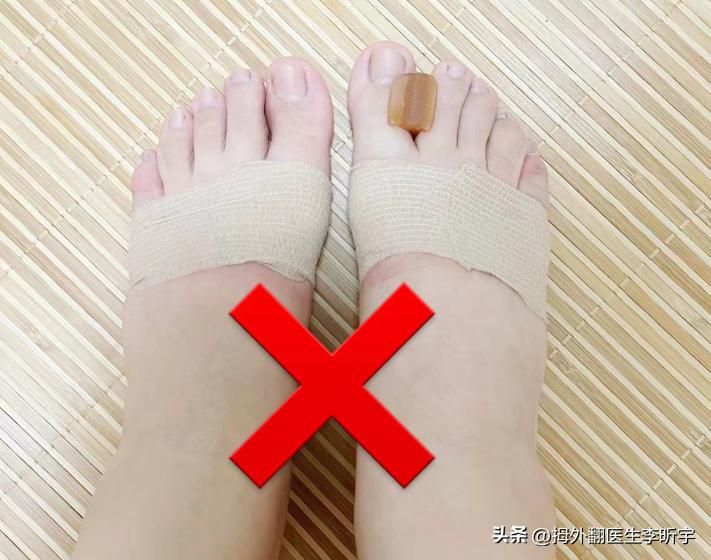 拇外翻矫正器真的有用吗,拇指外翻矫正器是智商税吗