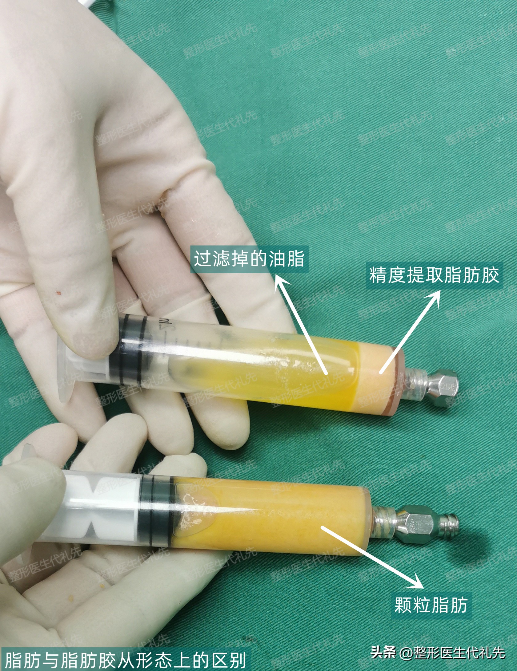 眼窝凹陷填充脂肪不成活怎么办,眼窝填充脂肪肿胀期眼睛睁不开