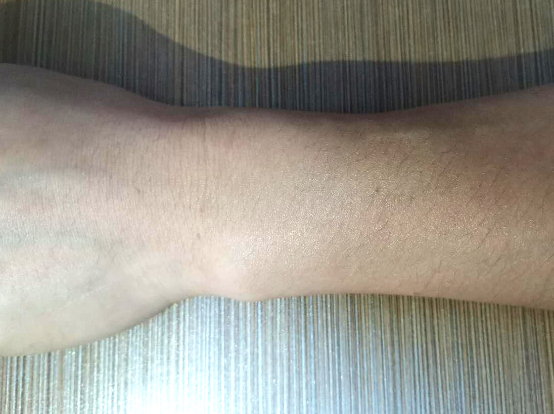 烟疤凸起疤痕怎么去除,河南疤痕增生去除方法