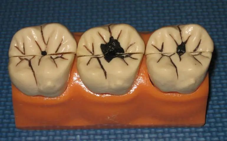 牙痛的最快止痛方法没有药吃,牙痛除了吃止痛药还有什么方法