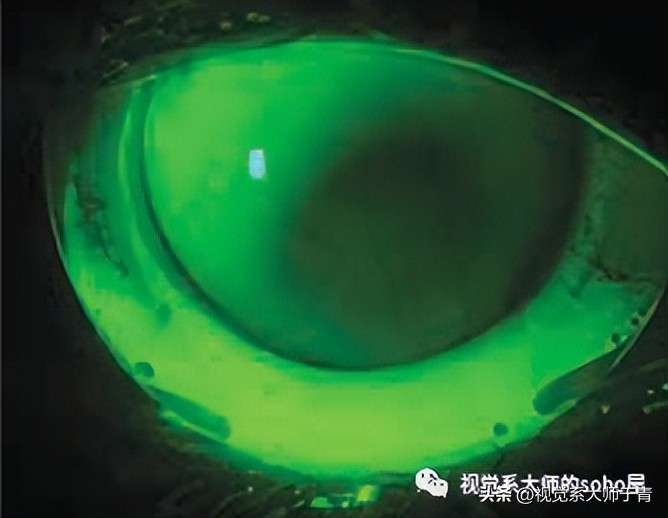 巩膜镜的验配技巧及案例分享,试戴巩膜镜成功率高不高