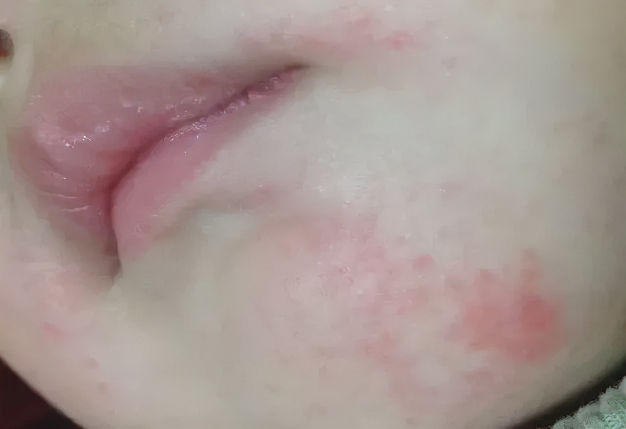 宝宝网红霜,用完宝宝霜长红疹了