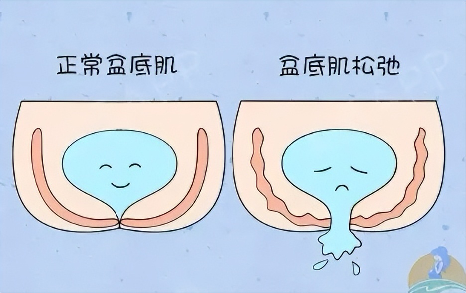 产后漏尿要怎么修复才能好,产后漏尿10个方法修复