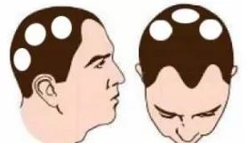 太“秃”然！如何守住“头”等大事