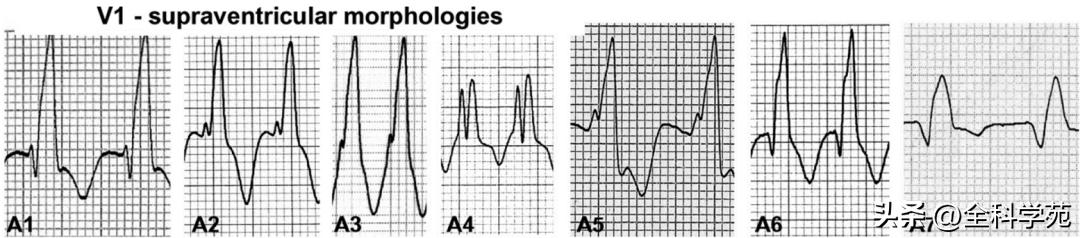 心电图上表现为宽qrs波,心电图中qrs是代表心动过速吗