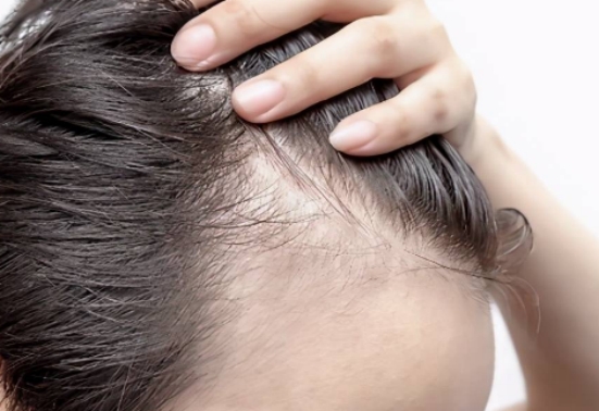 什么脱发用米诺和非那雄胺效果快,男性脱发用米诺地尔女性用什么