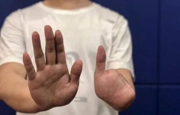 网传李赛高“挑脚筋”，他宣传的缅北你还心向往之吗？