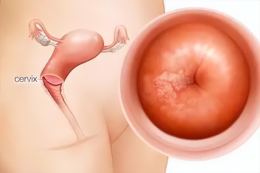 生理活动后出血白带增多怎么回事,做tct后出血多有脓性白带