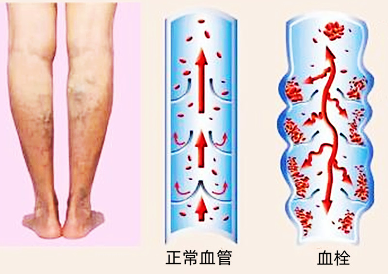 一只脚感觉肿胀是什么原因,一只脚莫名其妙的肿了用什么药