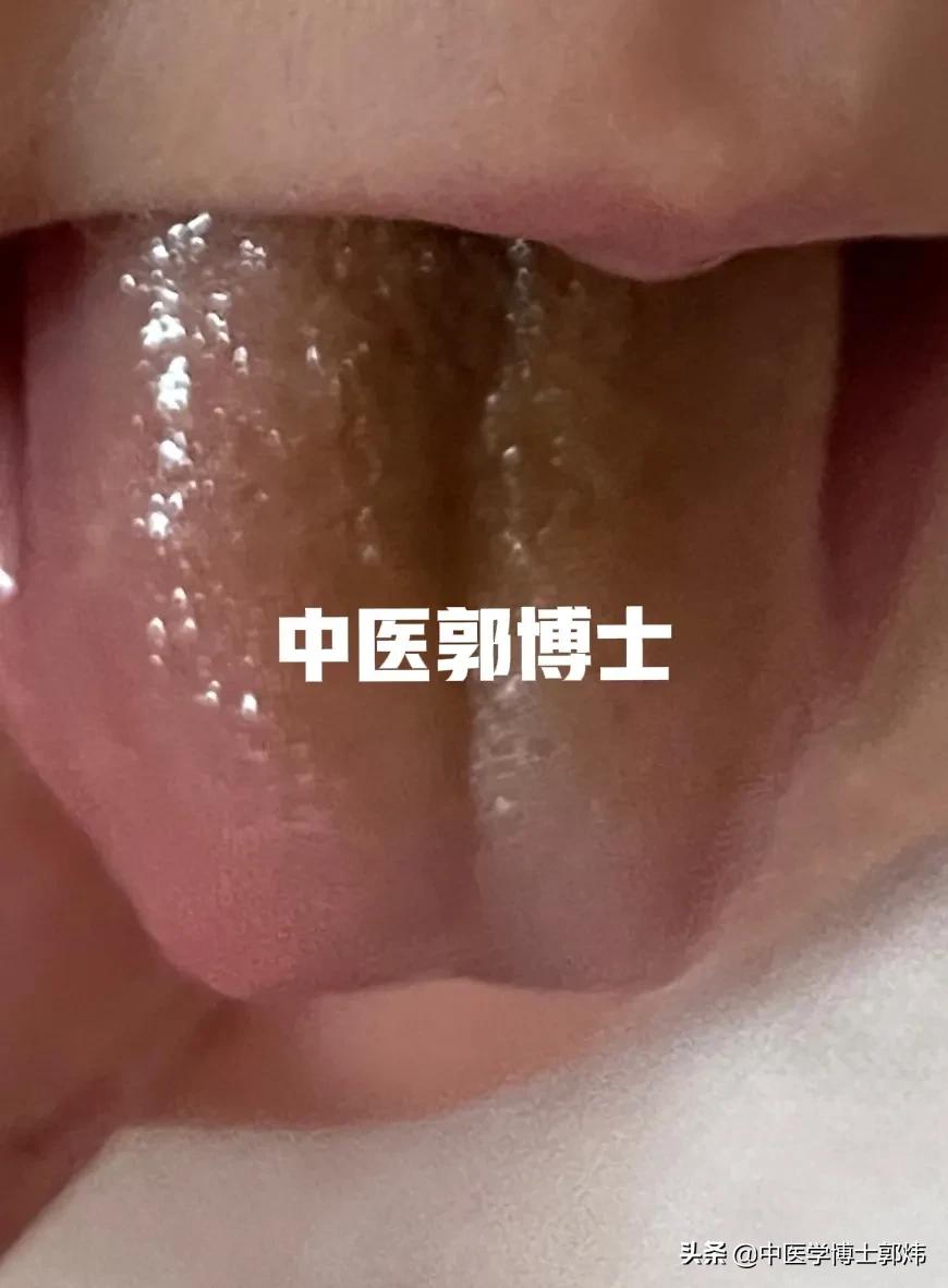 郭博说舌象（8）舌苔发黑，除了黑色食物染苔，可能是这两个原因