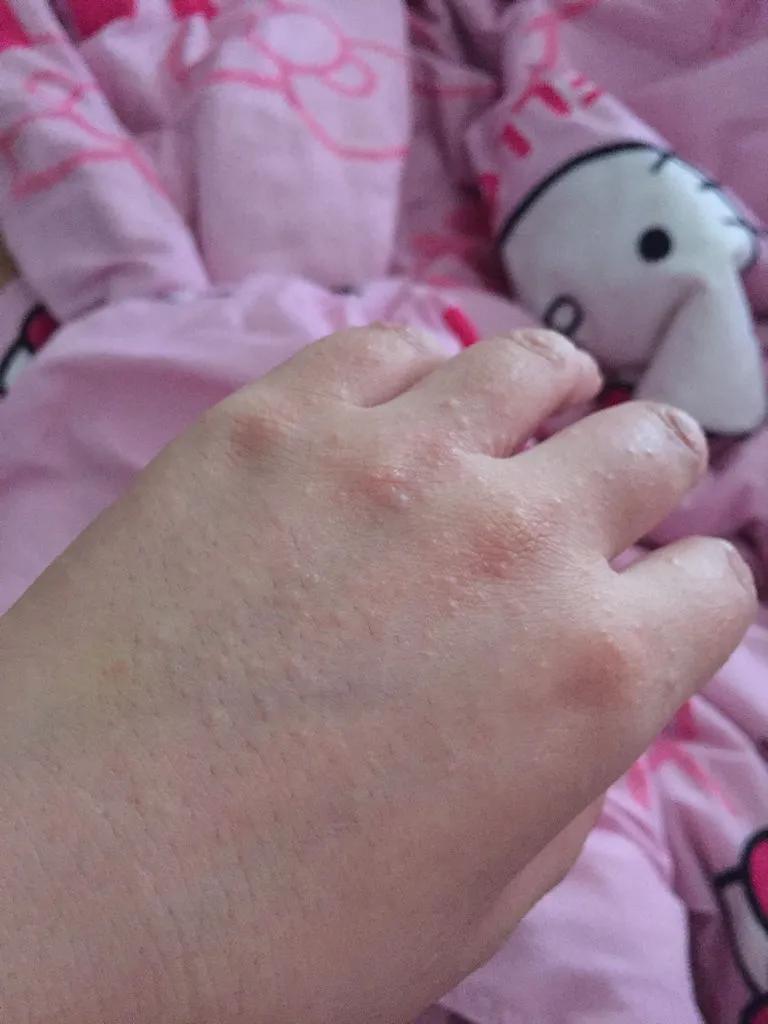 皮炎与湿疹如何鉴别及如何预防,新生儿热疹和湿疹的预防与护理