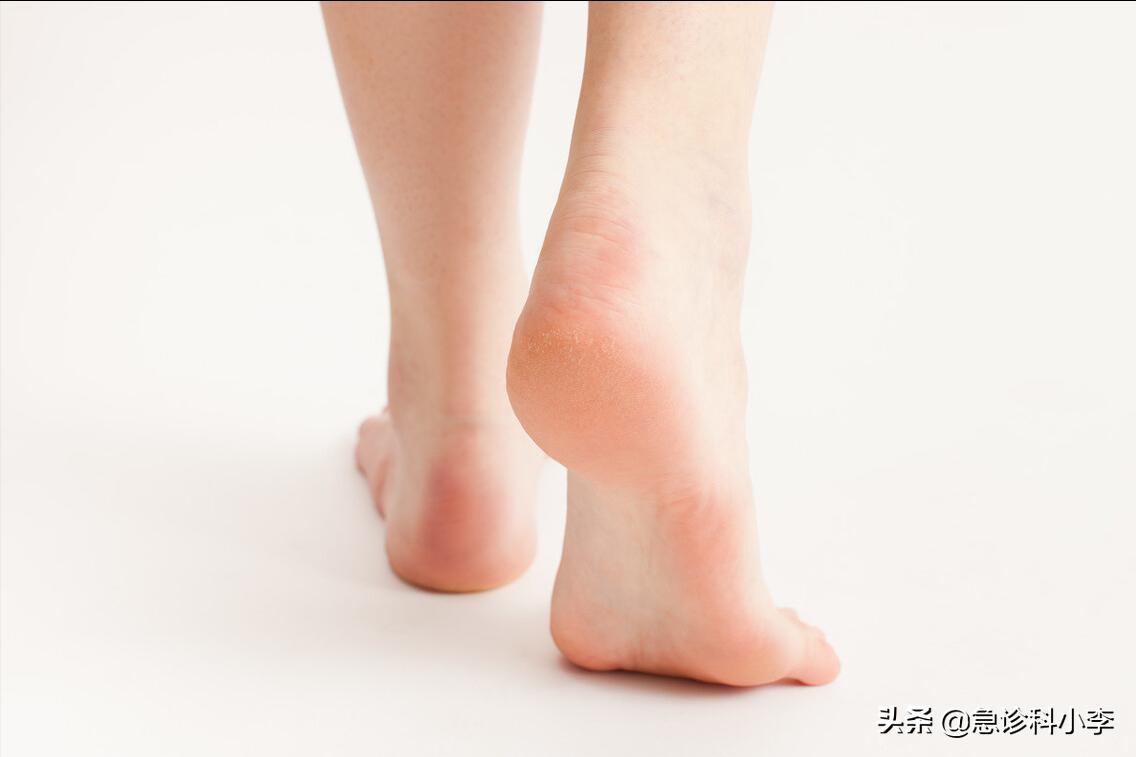 脚气反反复复怎么办？医生：教你2个实用方法，根治脚气不复发
