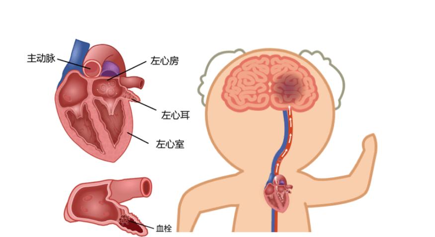 中药奇方三通汤，通心、脑、血管，通全身淤血，散于止痛