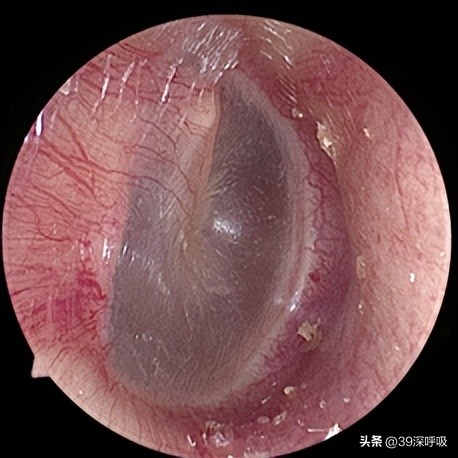 被扇嘴巴导致耳聋了,被人打了一巴掌导致神经性耳聋