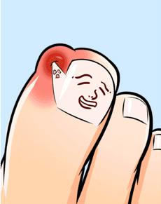 一走路脚指甲里疼怎么回事,一走路脚趾骨疼痛是什么原因呢